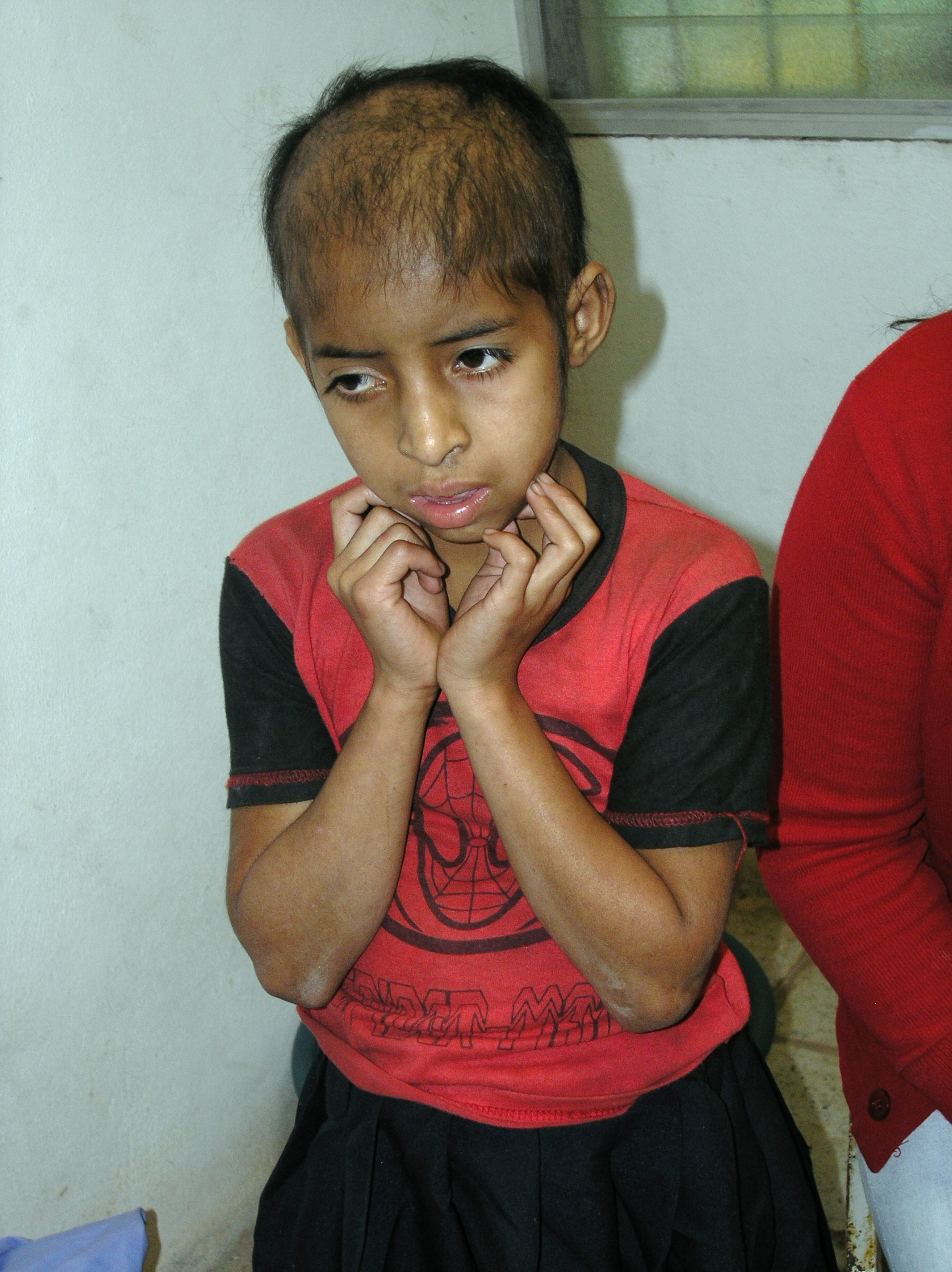 Girl suffering from severe malnutrition