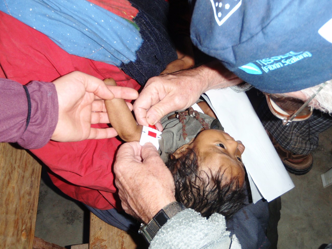 Small patient's arm is measured for level of malnutrition